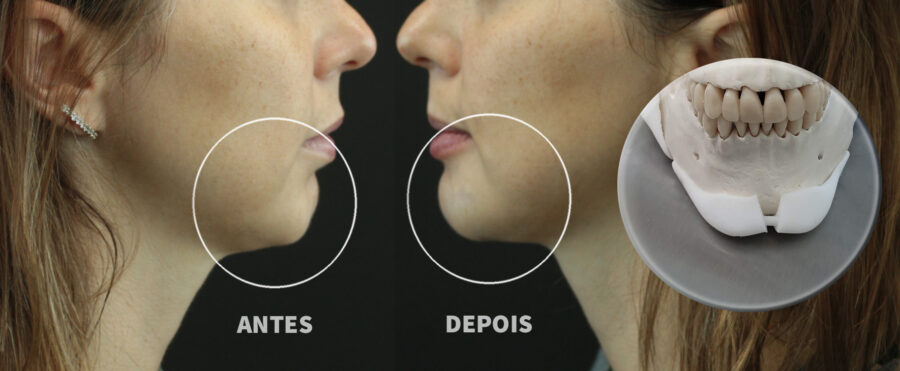 Harmonização Facial Definitiva com prótese de Polietileno