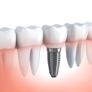 O que são implantes dentários e para que servem